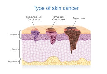 May is Skin Cancer & Melanoma Awareness Month - Cancer Exercise Training  Institute
