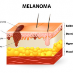 Exercise Programming for Melanoma