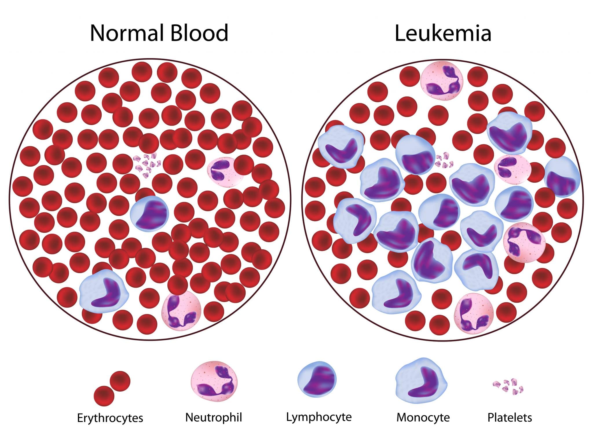 Эозинофильный лейкоцитоз. Острый лейкоз мазок крови. Лимфоцитоз картина крови. Клетки соединительной ткани эозинофилы. Острый лейкоз миелобластный микроскоп.